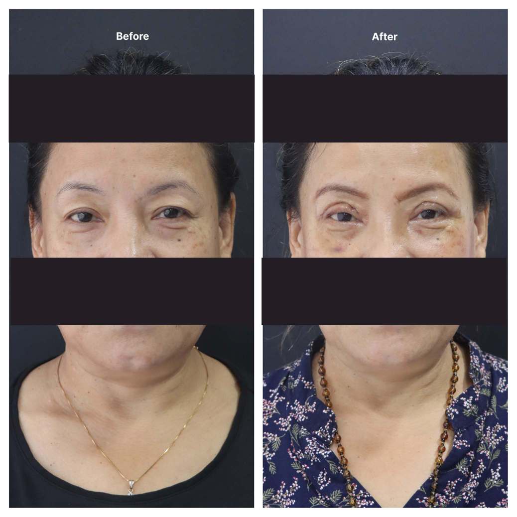 Eyelid Surgery KOQ10